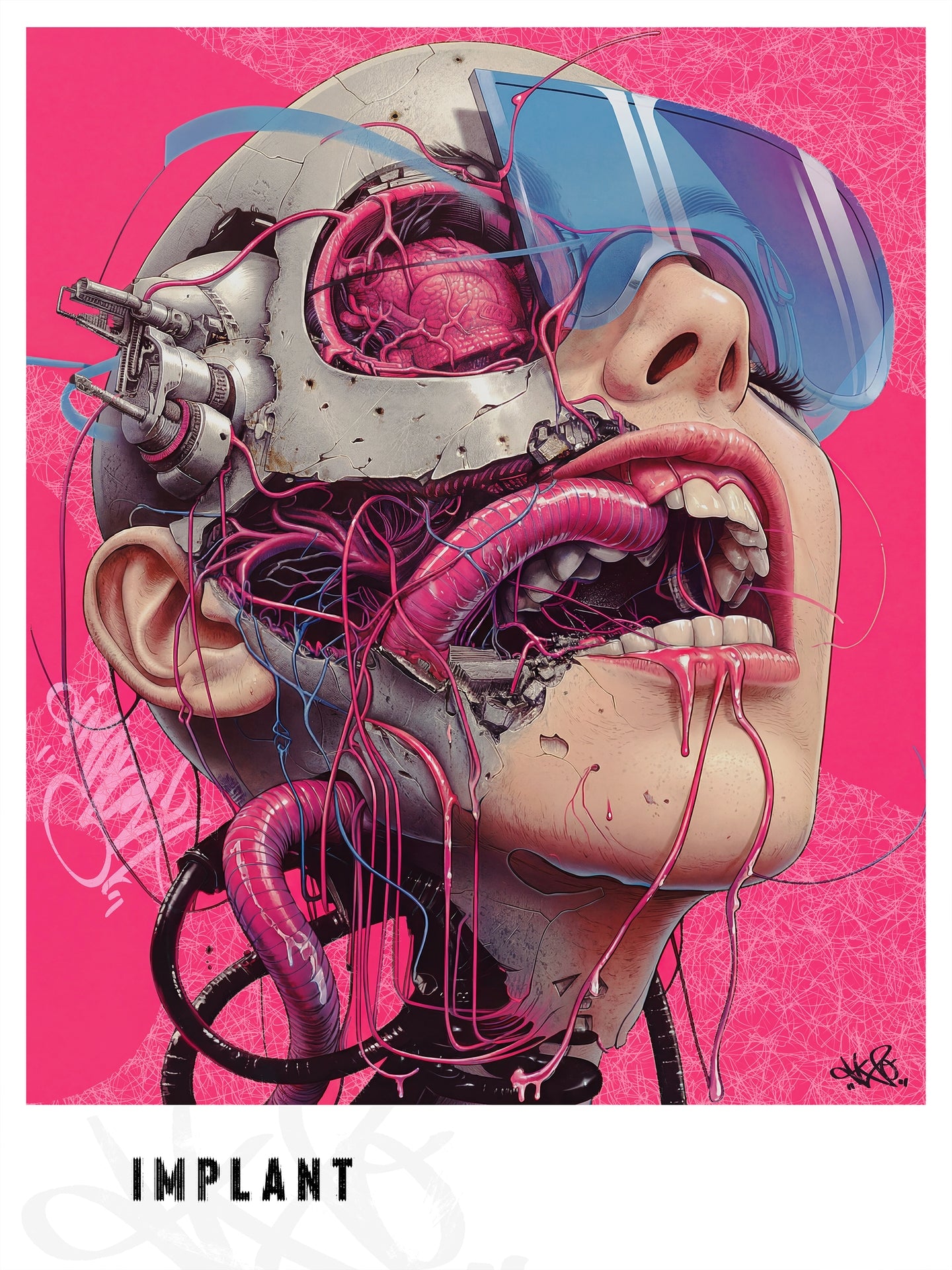Implant