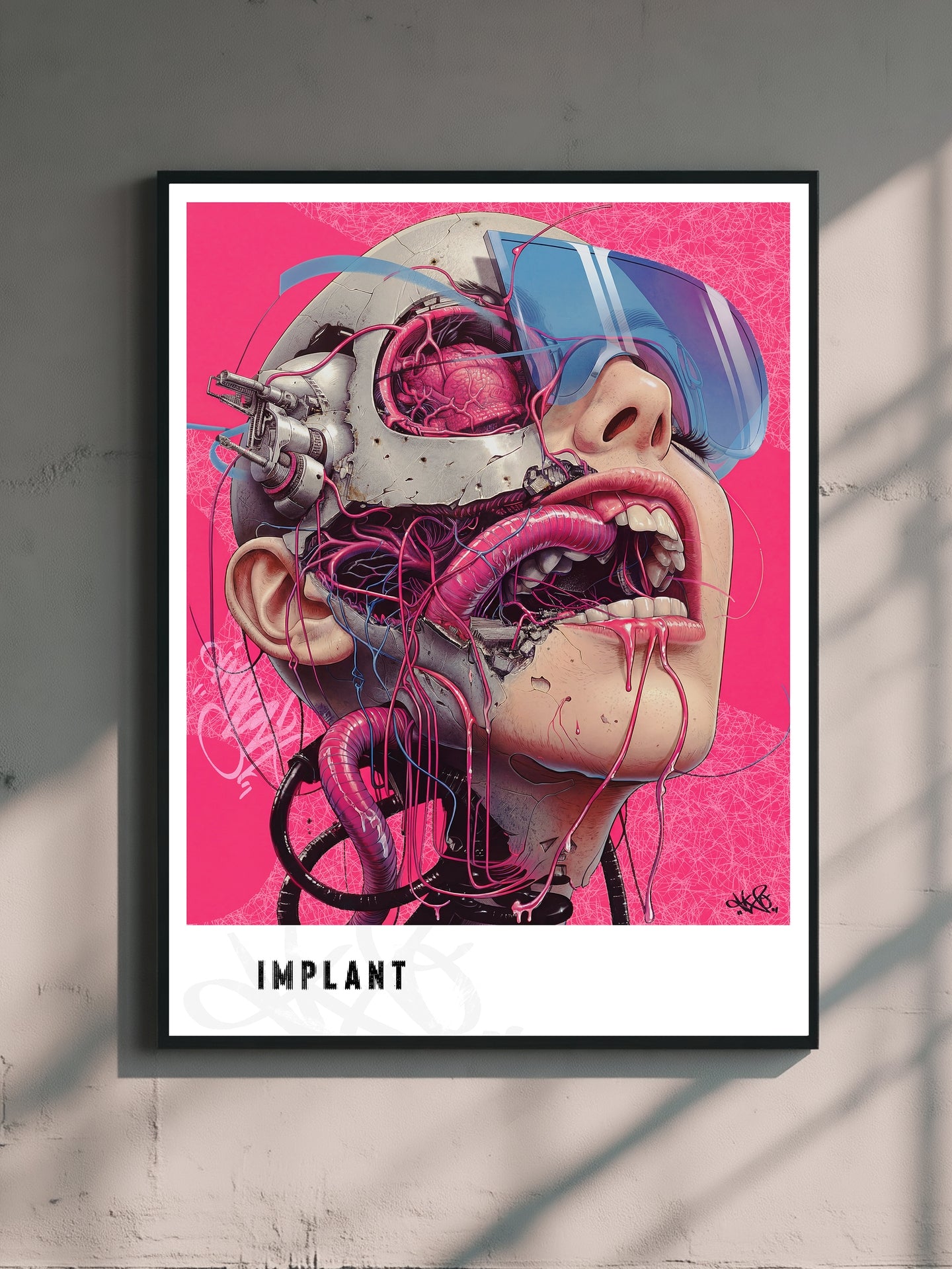 Implant